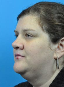 Rhinoplasty Before and After Pictures Indianapolis, IN