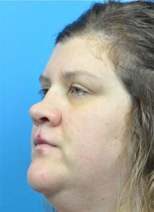 Rhinoplasty Before and After Pictures Indianapolis, IN