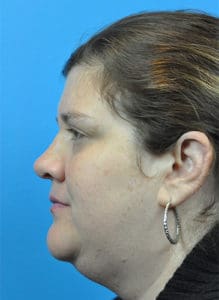 Rhinoplasty Before and After Pictures Indianapolis, IN