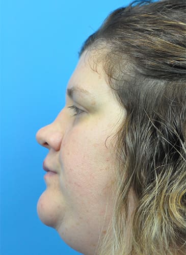 Rhinoplasty Before and After Pictures Indianapolis, IN