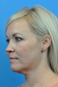 FaceTite Before and After Pictures Indianapolis, IN
