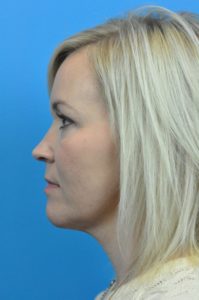 FaceTite Before and After Pictures Indianapolis, IN