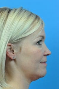 FaceTite Before and After Pictures Indianapolis, IN