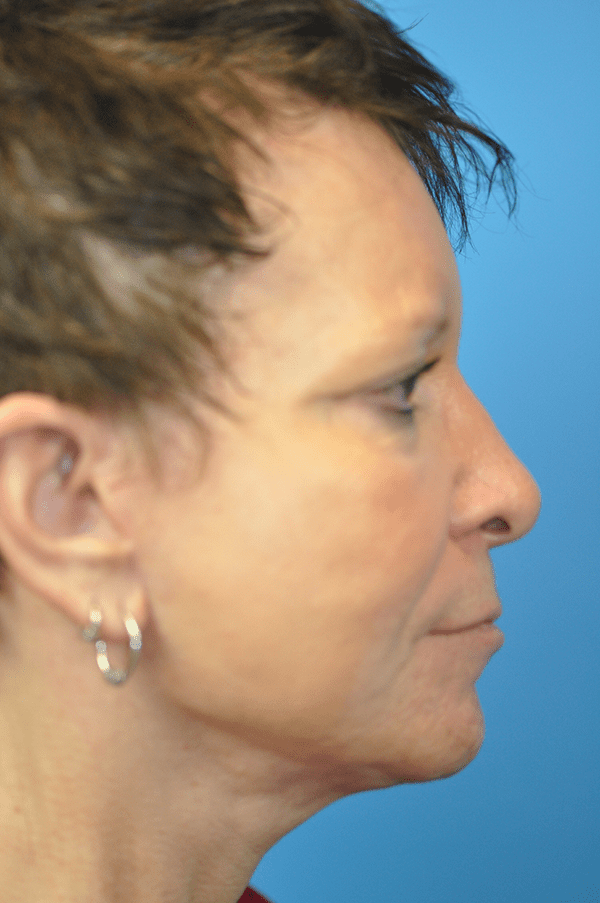 Facelift Before and After Pictures Indianapolis, IN