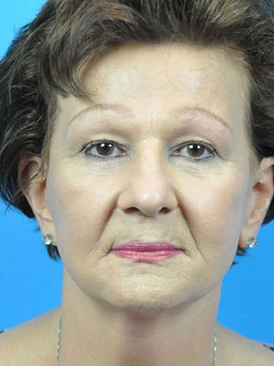 Facelift Before & After Pictures in Indianapolis, Indiana
