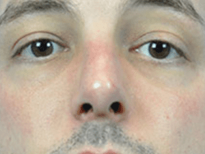 Rhinoplasty Before and After Pictures Indianapolis, IN