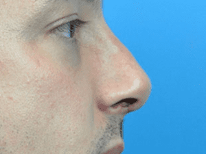 Rhinoplasty Before and After Pictures Indianapolis, IN