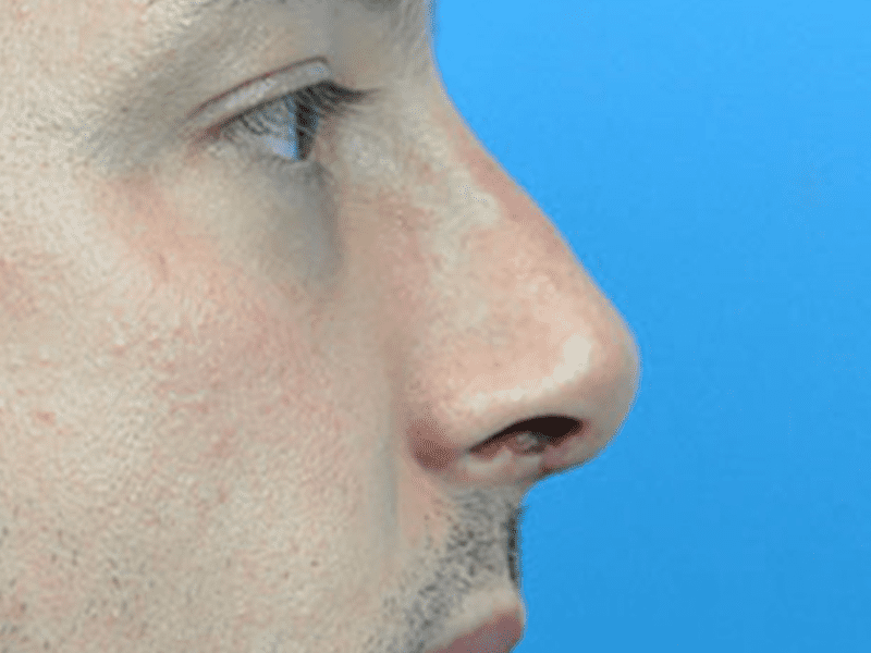 Rhinoplasty Before and After Pictures Indianapolis, IN