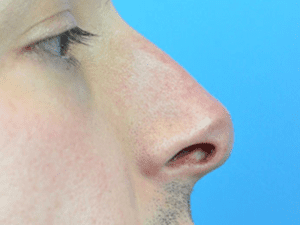 Rhinoplasty Before and After Pictures Indianapolis, IN
