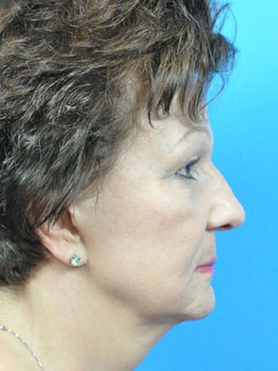 Facelift Before & After Pictures in Indianapolis, Indiana