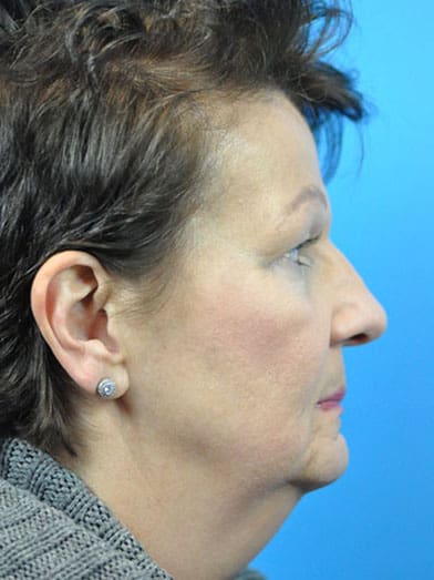 Facelift Before & After Pictures in Indianapolis, Indiana
