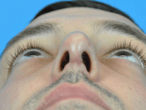 Rhinoplasty Before and After Pictures Indianapolis, IN
