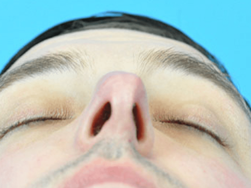 Rhinoplasty Before and After Pictures Indianapolis, IN