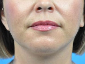 Facelift Before and After Pictures Indianapolis, IN