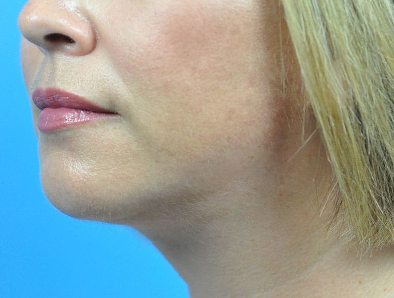 Facelift Before and After Pictures Indianapolis, IN