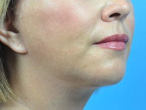 Facelift Before and After Pictures Indianapolis, IN