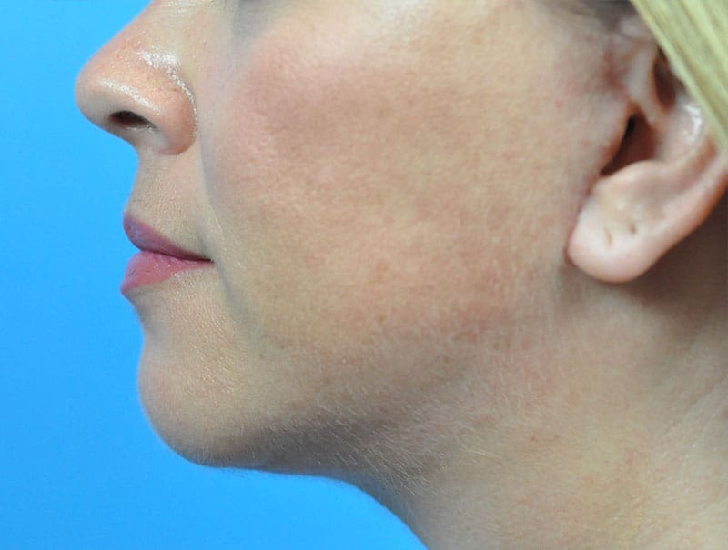 Facelift Before and After Pictures Indianapolis, IN