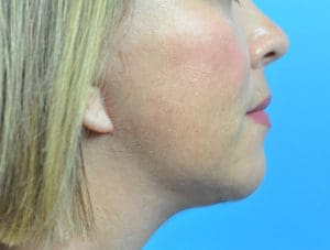 Facelift Before and After Pictures Indianapolis, IN