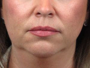 Facelift Before and After Pictures Indianapolis, IN