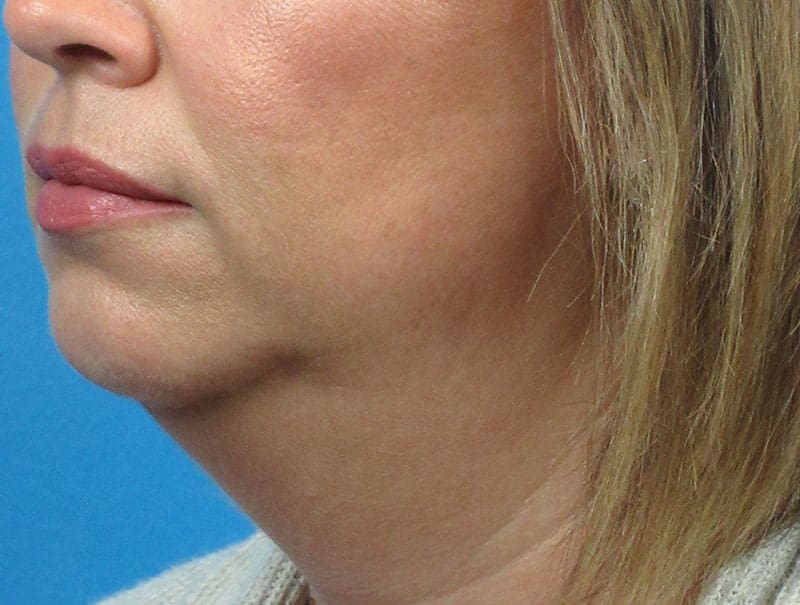 Facelift Before and After Pictures Indianapolis, IN