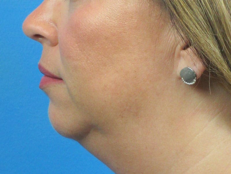 Facelift Before and After Pictures Indianapolis, IN