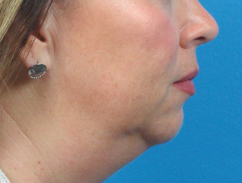 Facelift Before and After Pictures Indianapolis, IN