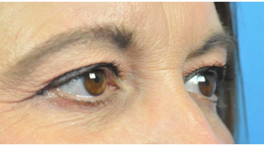 Blepharoplasty Before and After Pictures in Indianapolis, IN