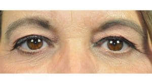 Blepharoplasty Before and After Pictures in Indianapolis, IN