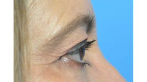 Blepharoplasty Before and After Pictures in Indianapolis, IN