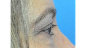 Blepharoplasty Before and After Pictures in Indianapolis, IN