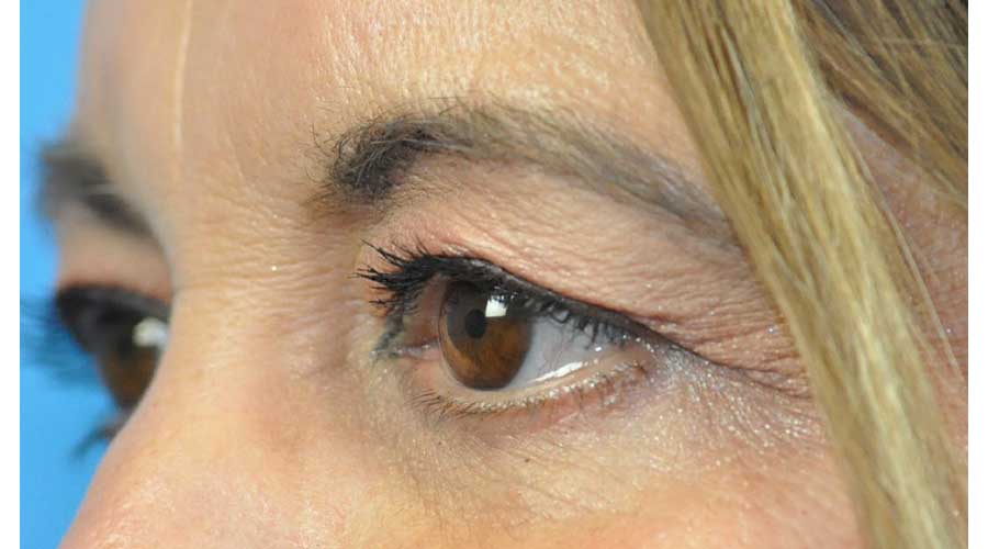 Blepharoplasty Before and After Pictures in Indianapolis, IN