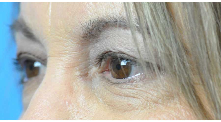 Blepharoplasty Before and After Pictures in Indianapolis, IN