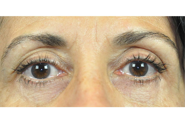 Blepharoplasty Before & After Pictures in Indianapolis, Indiana