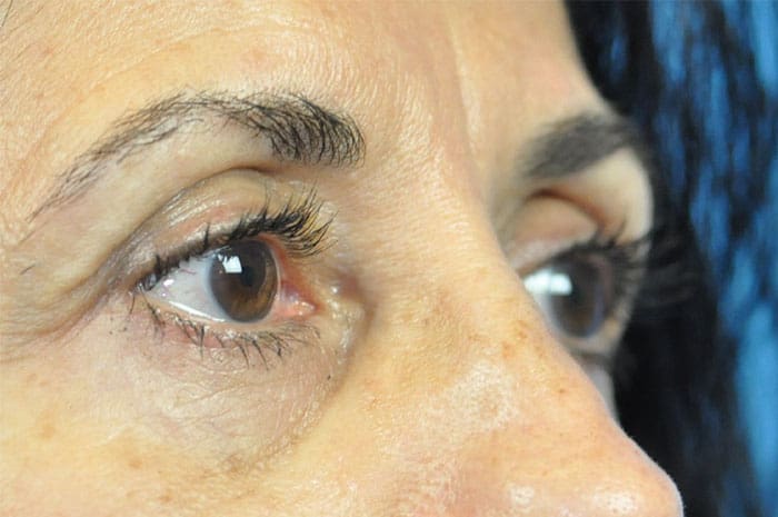 Blepharoplasty Before & After Pictures in Indianapolis, Indiana