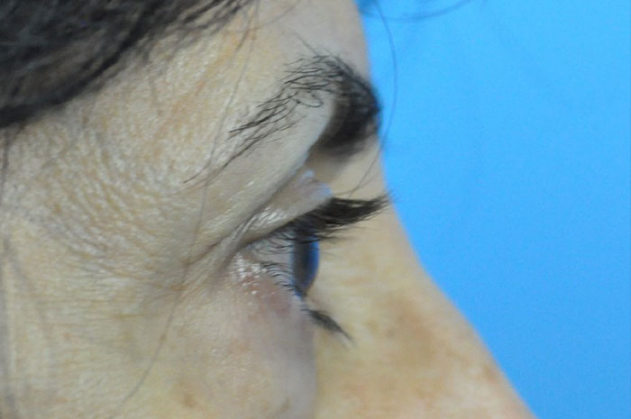 Blepharoplasty Before & After Pictures in Indianapolis, Indiana