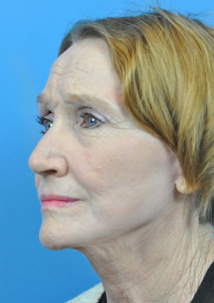Facelift Before & After Pictures in Indianapolis, Indiana