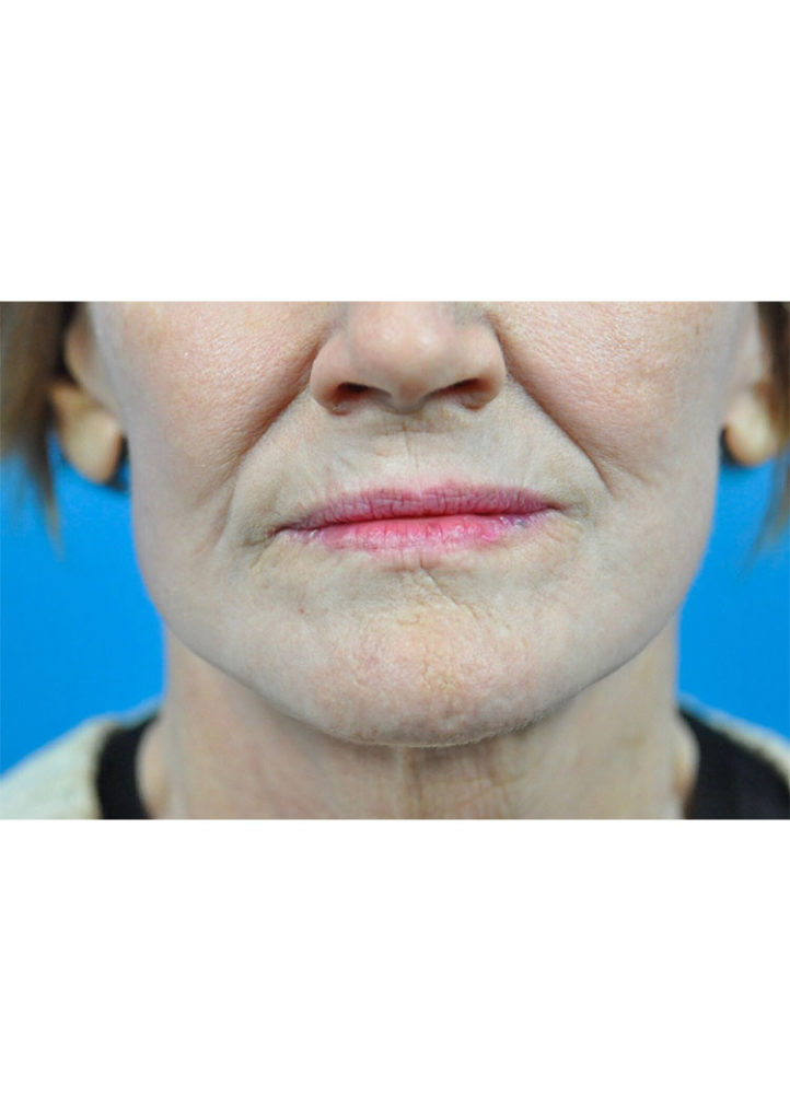 Facelift Before & After Pictures in Indianapolis, Indiana