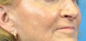 Cheek Augmentation Before and After Pictures Indianapolis, IN