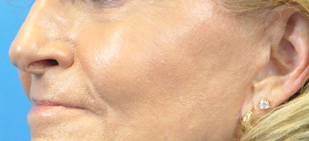 Cheek Augmentation Before and After Pictures Indianapolis, IN