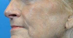 Cheek Augmentation Before and After Pictures Indianapolis, IN