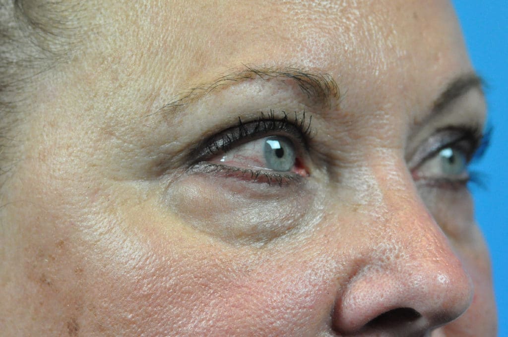 Blepharoplasty Before & After Pictures in Indianapolis, Indiana