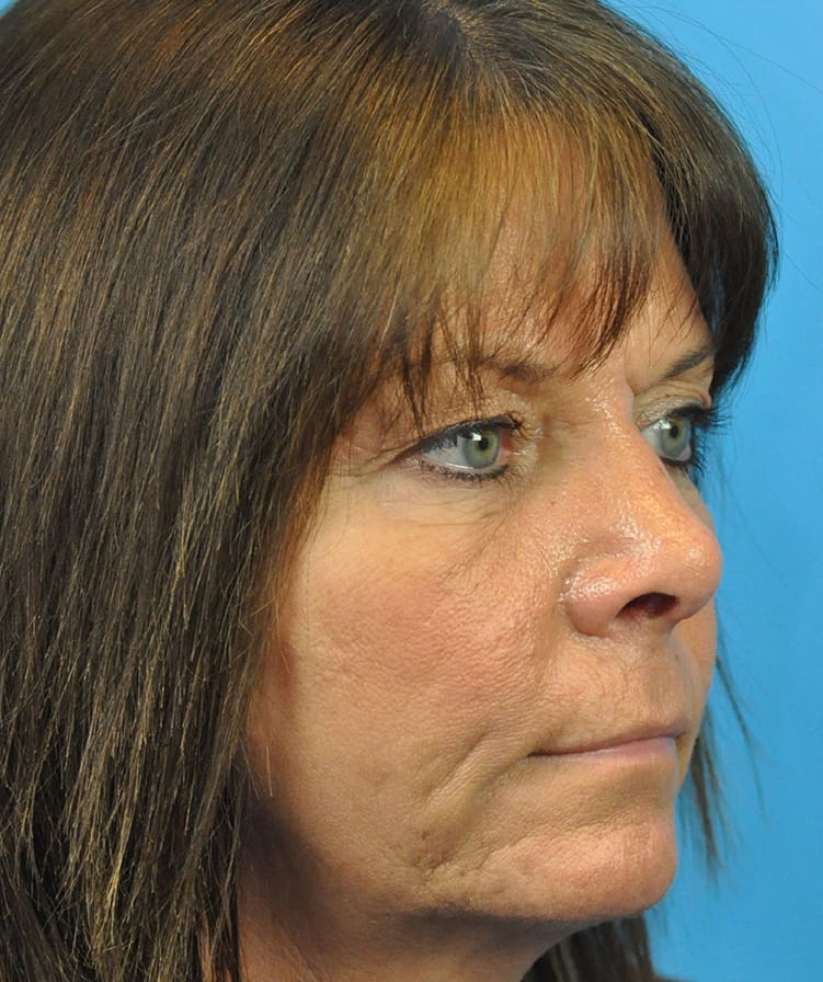 Rhinoplasty Before & After Pictures in Indianapolis, Indiana