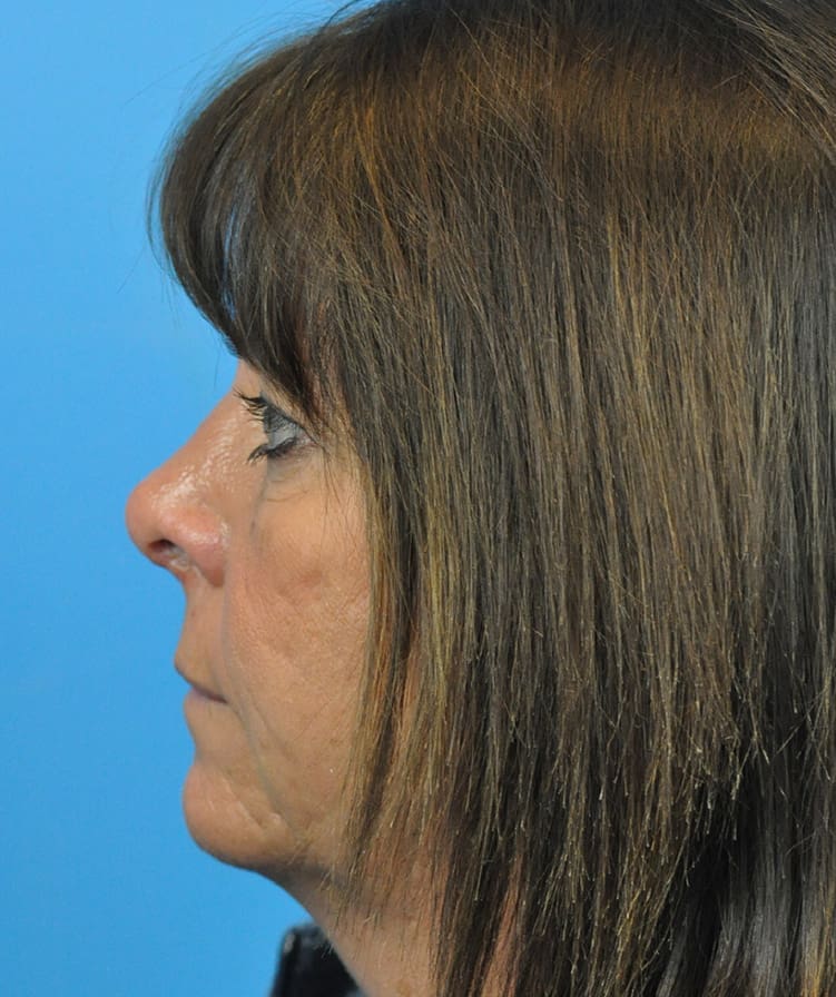 Rhinoplasty Before & After Pictures in Indianapolis, Indiana