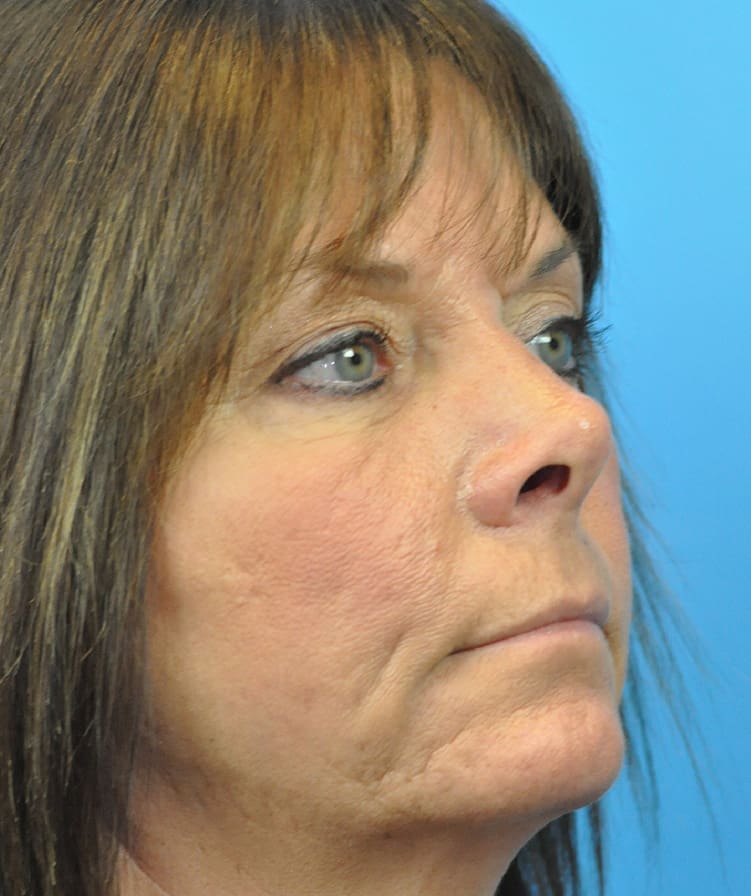 Rhinoplasty Before & After Pictures in Indianapolis, Indiana
