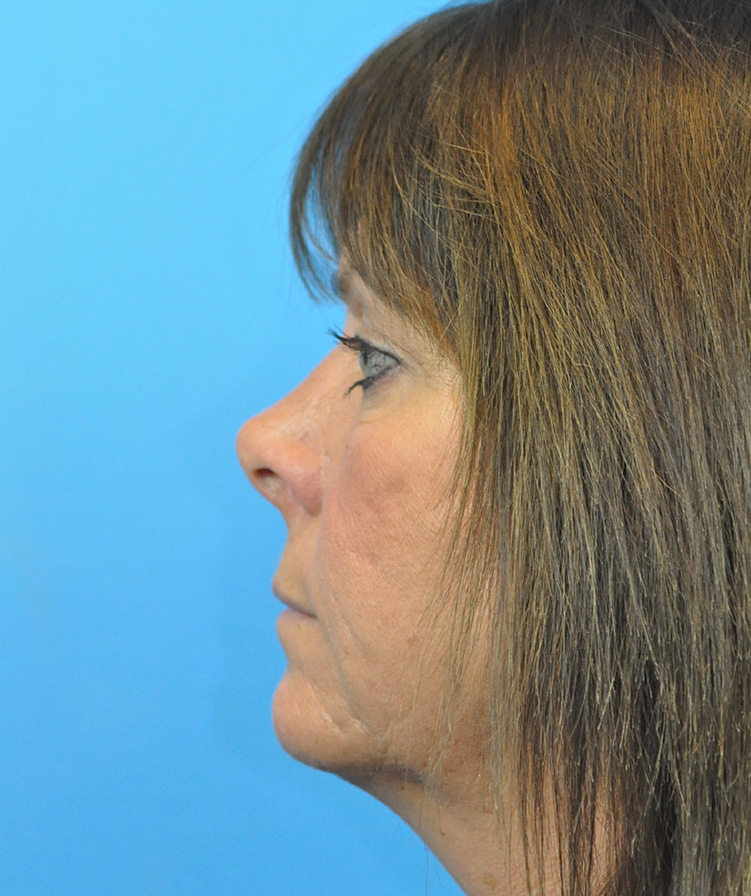 Rhinoplasty Before & After Pictures in Indianapolis, Indiana