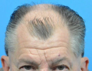 Hair Transplant Before and After Pictures Indianapolis, IN