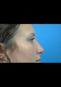 Rhinoplasty Before and After Pictures Indianapolis, IN