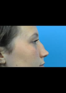 Rhinoplasty Before and After Pictures Indianapolis, IN