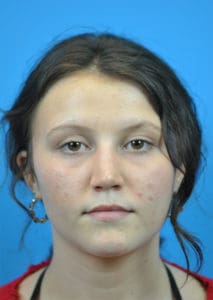 Rhinoplasty Before and After Pictures Indianapolis, IN