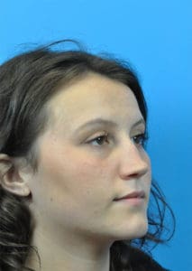 Rhinoplasty Before and After Pictures Indianapolis, IN